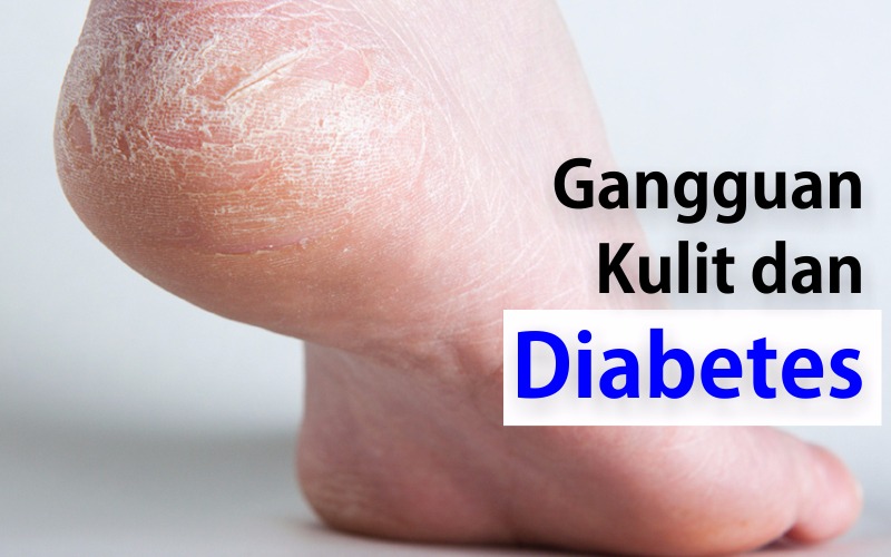 Gangguan Kulit dan Diabetes