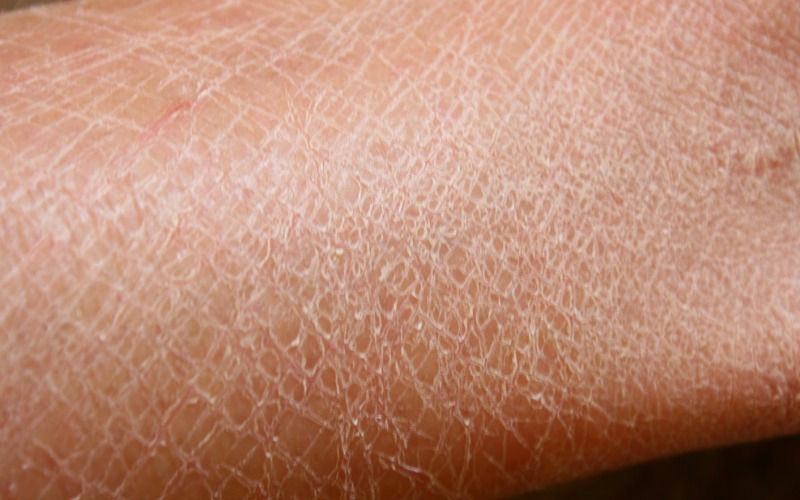 Gangguan Kulit dan Diabetes