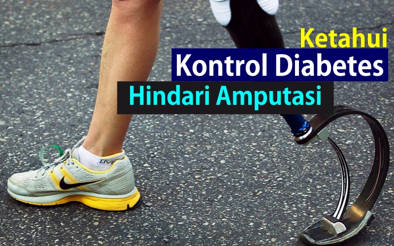 Ketahui, Kontrol Diabetes, Hindari Amputasi