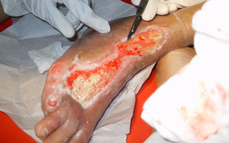 Tips Diabetes - Perawatan Kaki Diabetasi