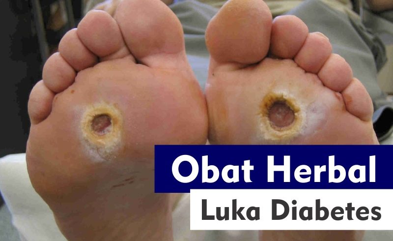 Obat Luka Diabetes Bentuk Herbal